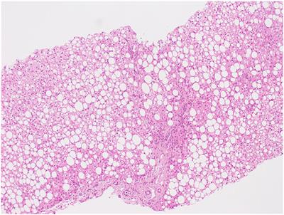 Case report: NAFLD and maple syrup urine disease: Is there an interplay between branched-chain amino acids and fructose consumption?